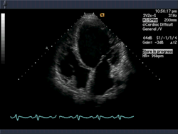 Echocardiography